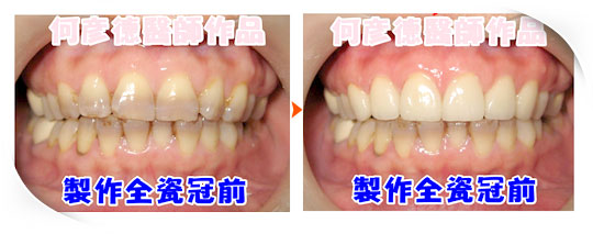 上排牙齒共6顆，已改善牙齒色澤