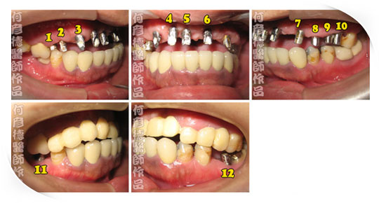 徐先生 口腔重建 全口植牙共植12顆，( 口內實景 植牙中 )