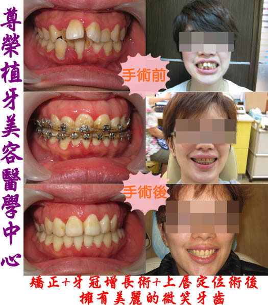 矯正+上唇定位術+牙冠增長術後擁有美麗的微笑牙齒