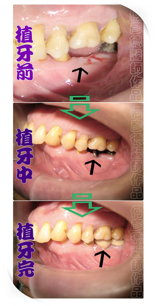 植牙前、植牙後、植牙後