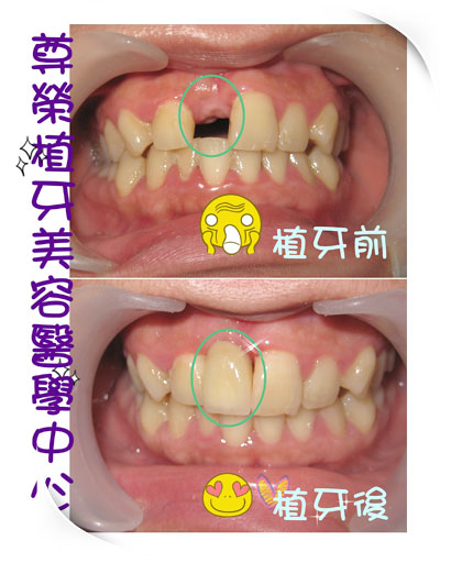 植牙專科醫師 Dr.何彥德- 3D水雷射微創人工植牙