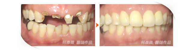 製作"晶鑽全瓷冠"+"牙齦微整形"