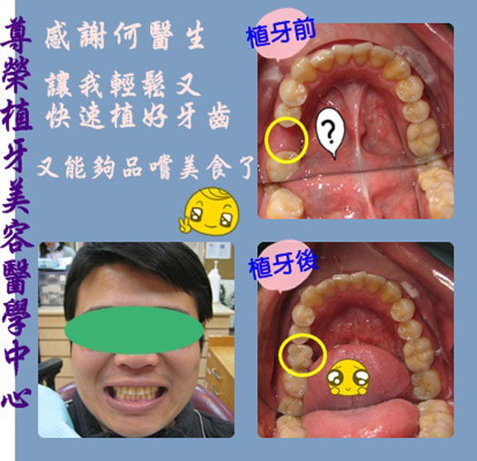 感謝何醫師，讓我輕鬆又快速植好牙齒又能夠品嚐美食了