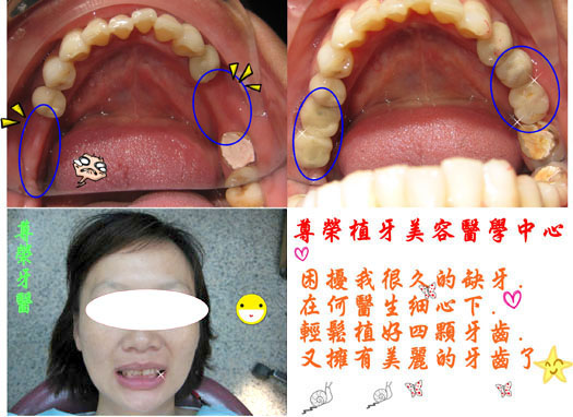 困擾很久的缺牙在何醫師細心下，輕鬆植好四顆牙齒又擁有美麗的牙齒了。