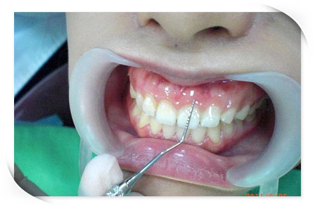 何醫生幫我預估約修4顆牙齒大門牙修2mm在加門牙旁邊的2顆牙