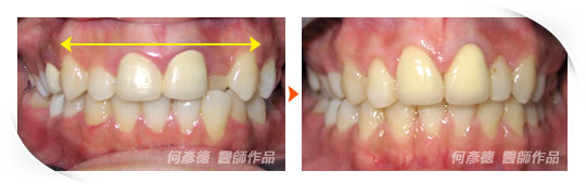 側面門牙內凹，笑時露牙齒，牙齒短小。