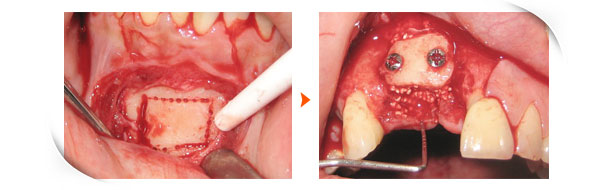 自體骨移植補骨術(Autogensis bone block graft)