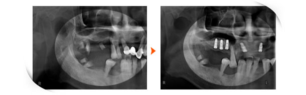 上顎竇骨增高術(Sinus lift)